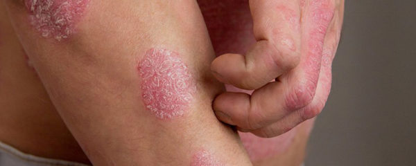 psoriasis